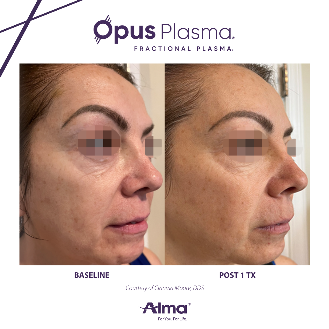 A before and after photo of a woman 's face for opus plasma