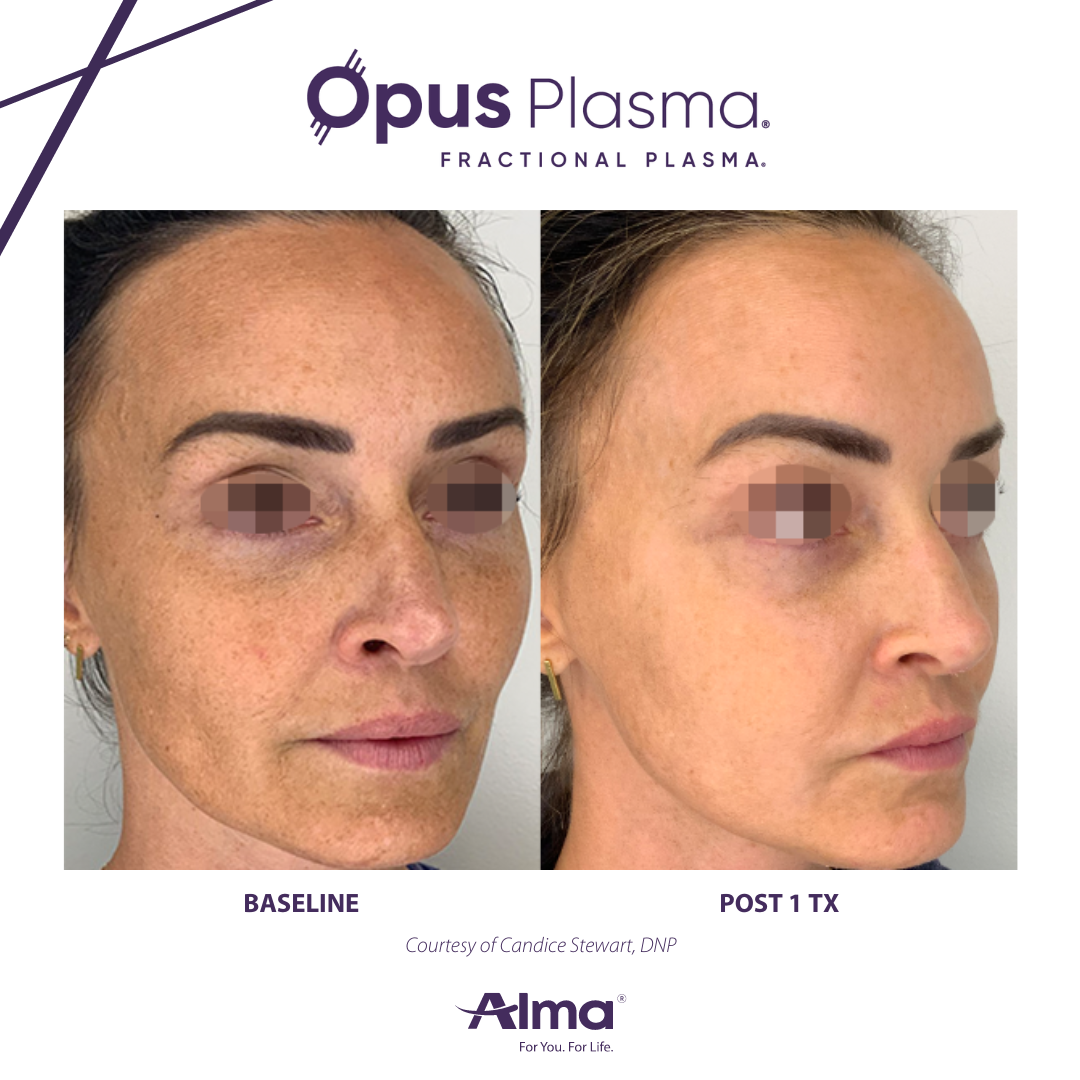 A before and after photo of a woman 's face.