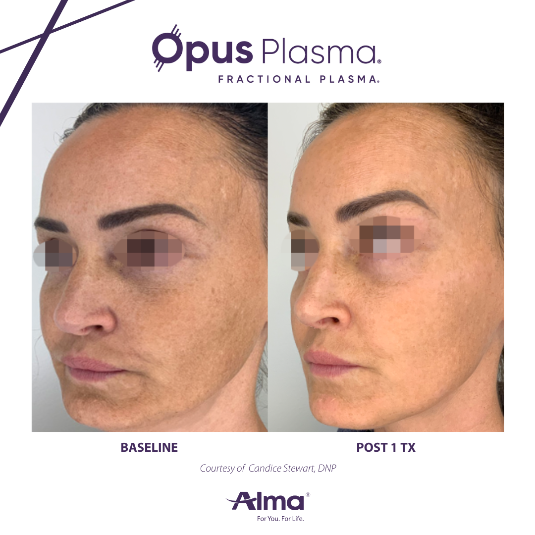 A before and after photo of a woman 's face