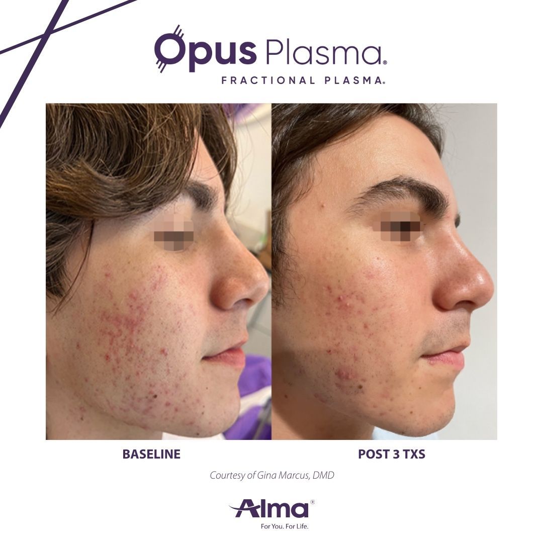 A before and after photo of a man 's face with acne