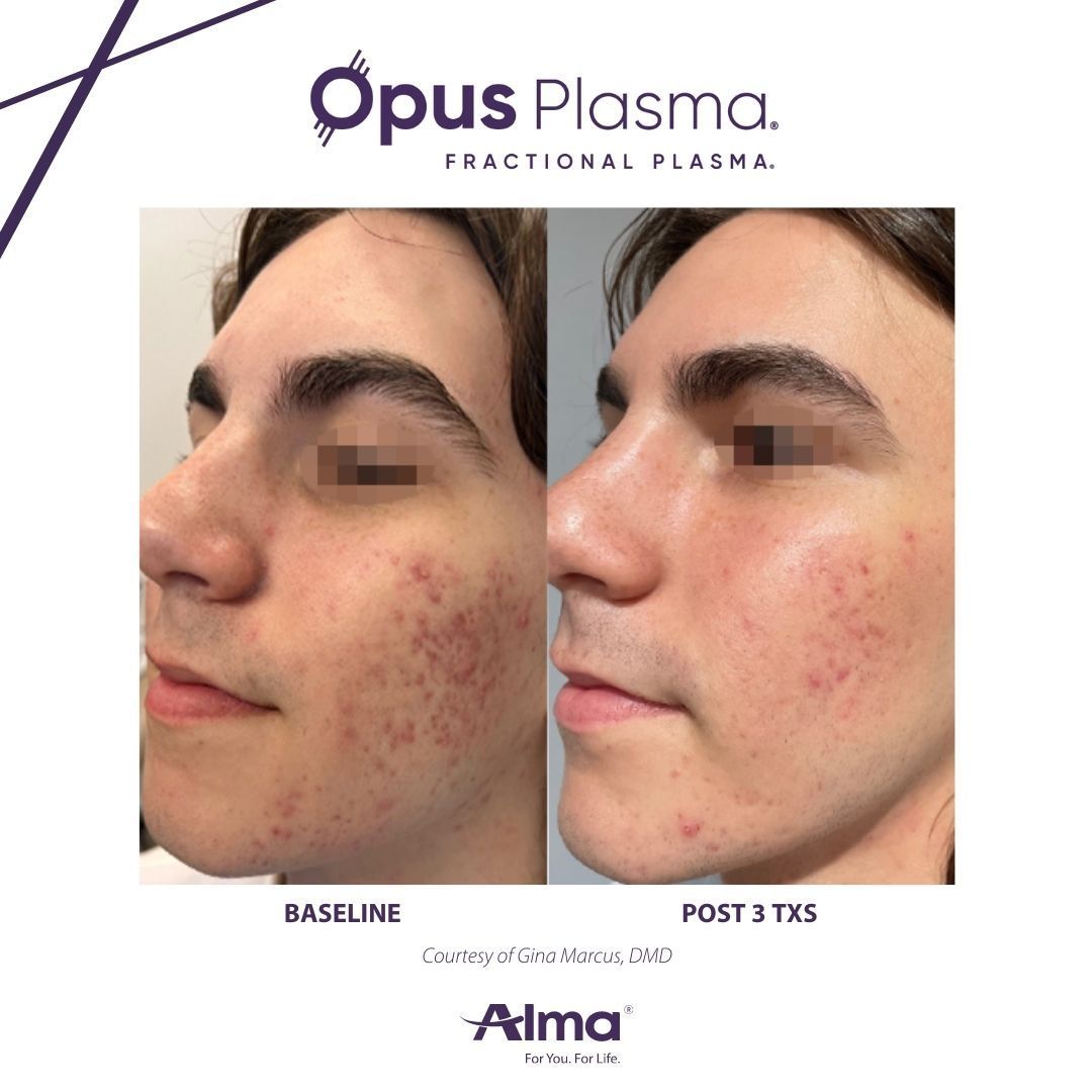 A before and after photo of a man 's face for opus plasma