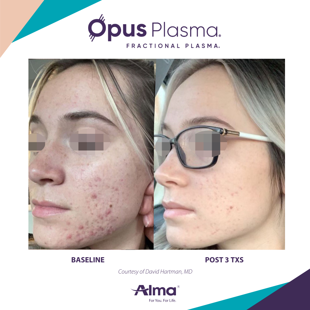 A before and after photo of a woman 's face for opus plasma