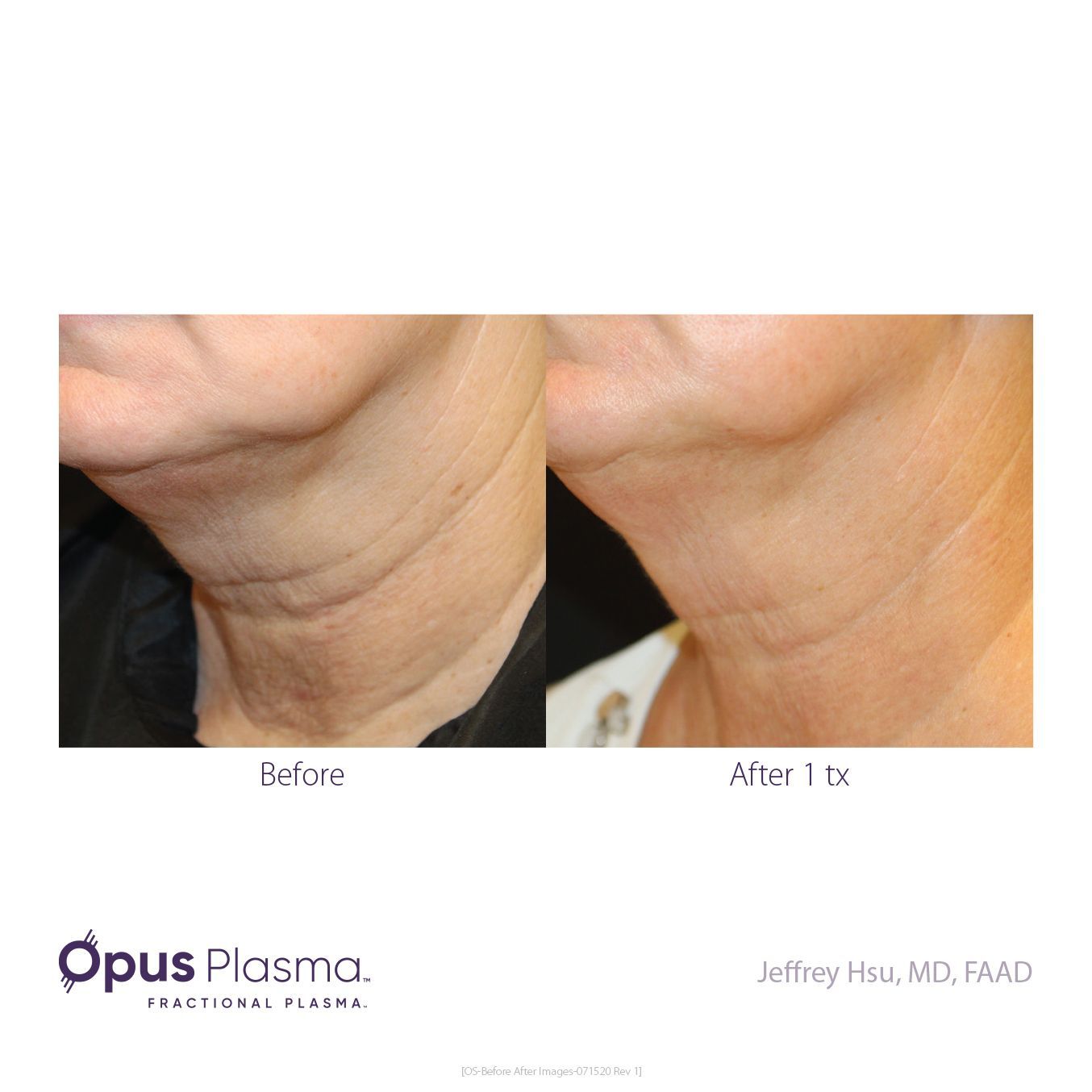 A before and after photo of a woman 's neck