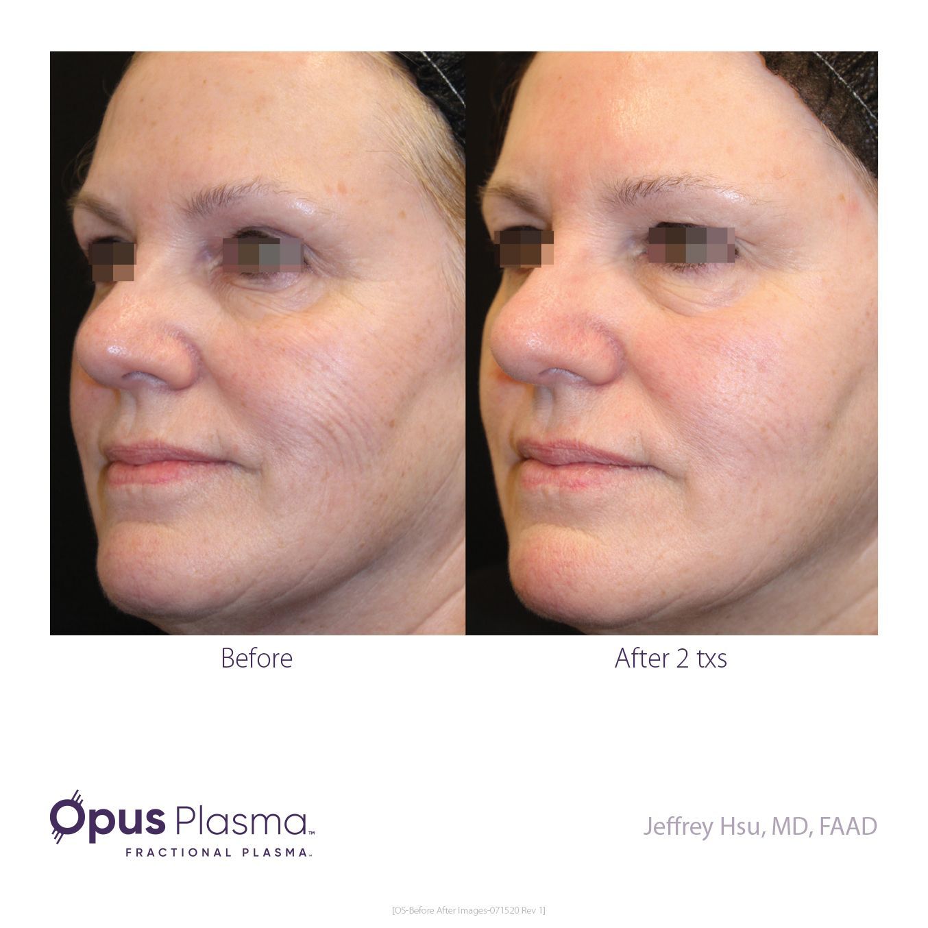 A before and after photo of a woman 's face by opus plasma