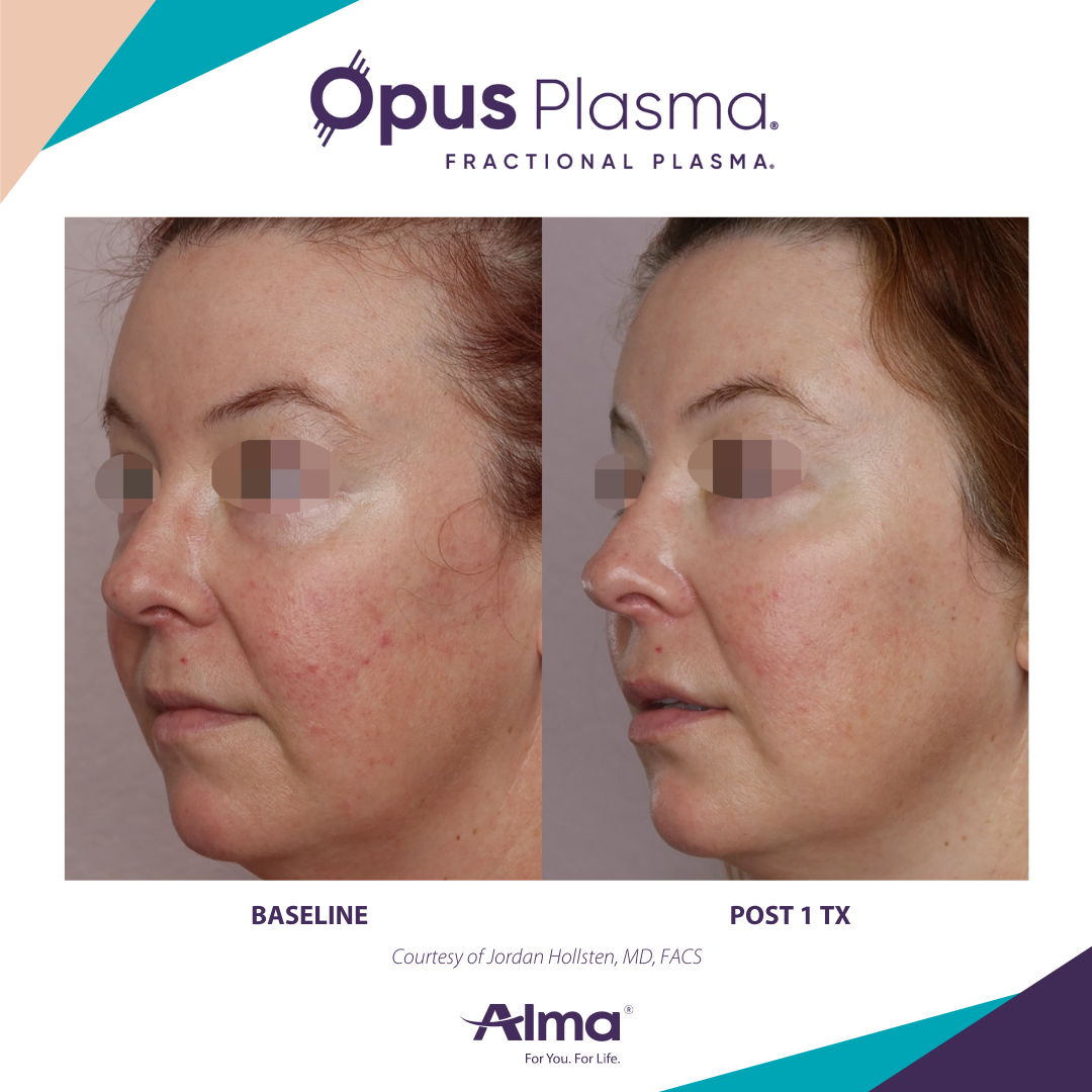 A before and after photo of a woman 's face for opus plasma