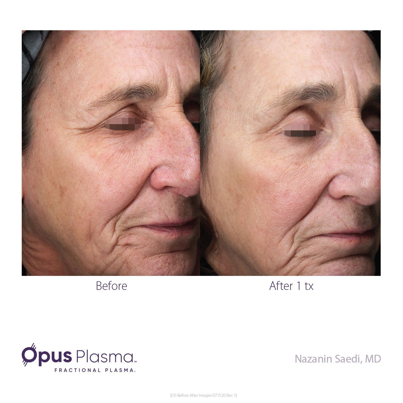 A before and after photo of a woman 's face.