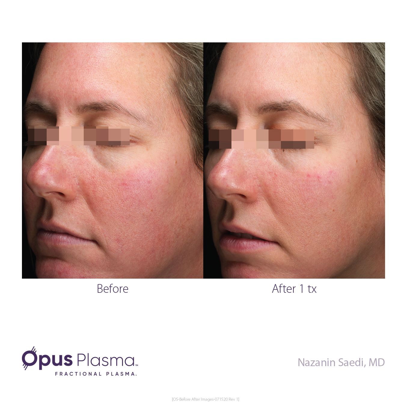 A before and after photo of a woman 's face