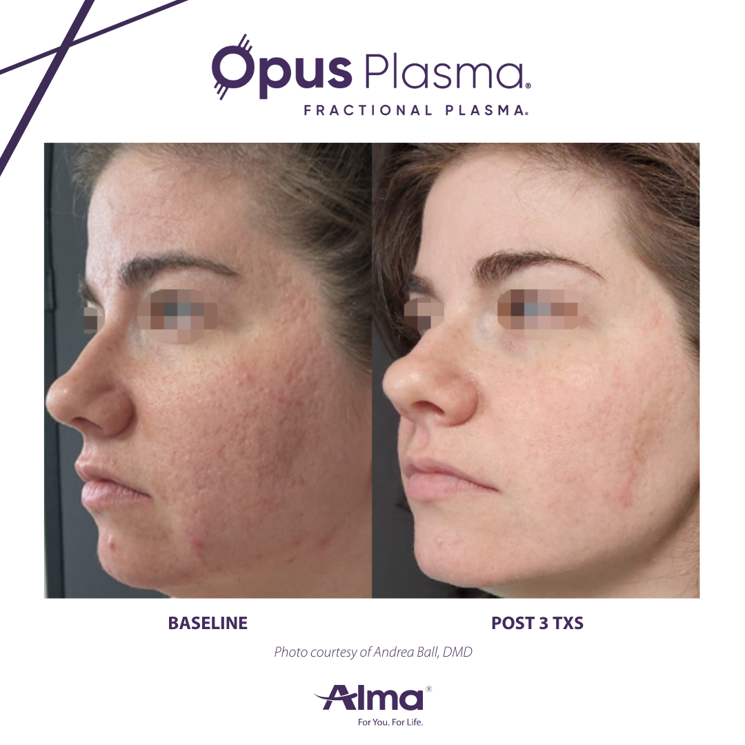 A before and after photo of a woman 's face for opus plasma