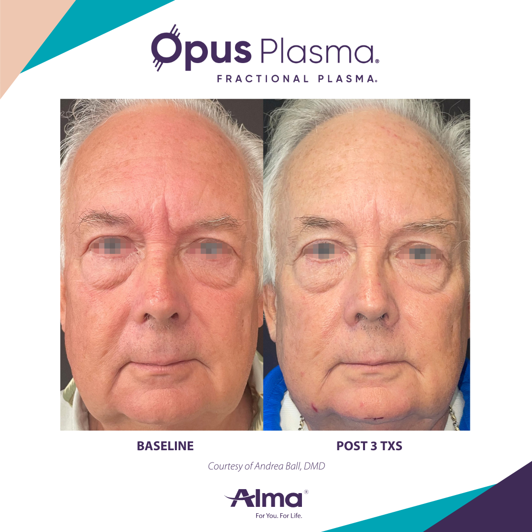 A before and after photo of an older man 's face