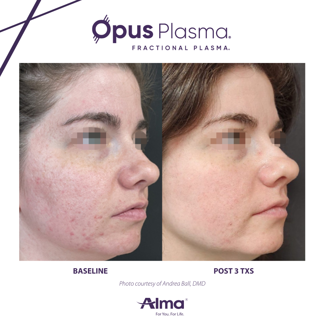 A before and after photo of a woman 's face for opus plasma
