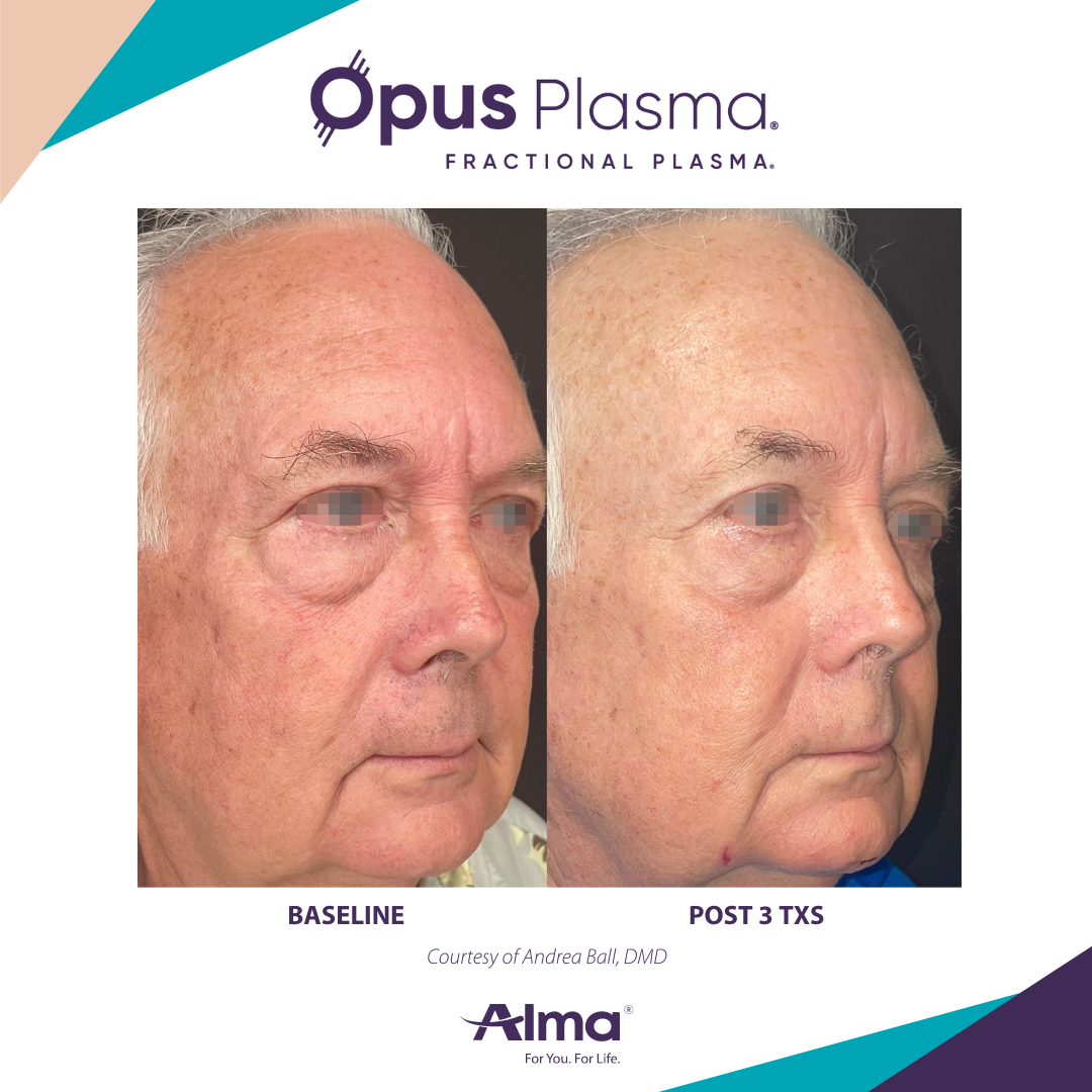 A before and after photo of an older man 's face