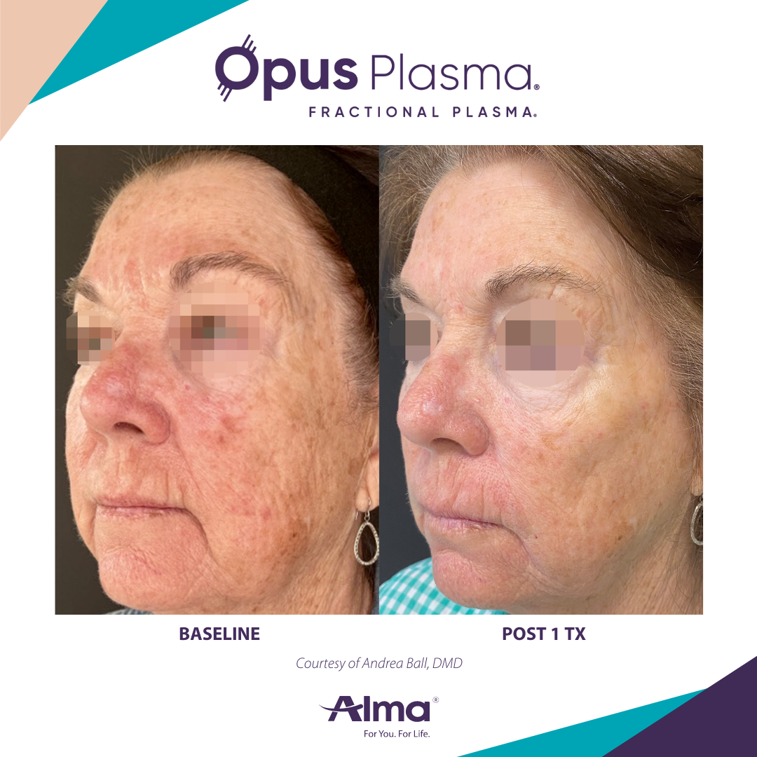 A before and after photo of a woman 's face for opus plasma