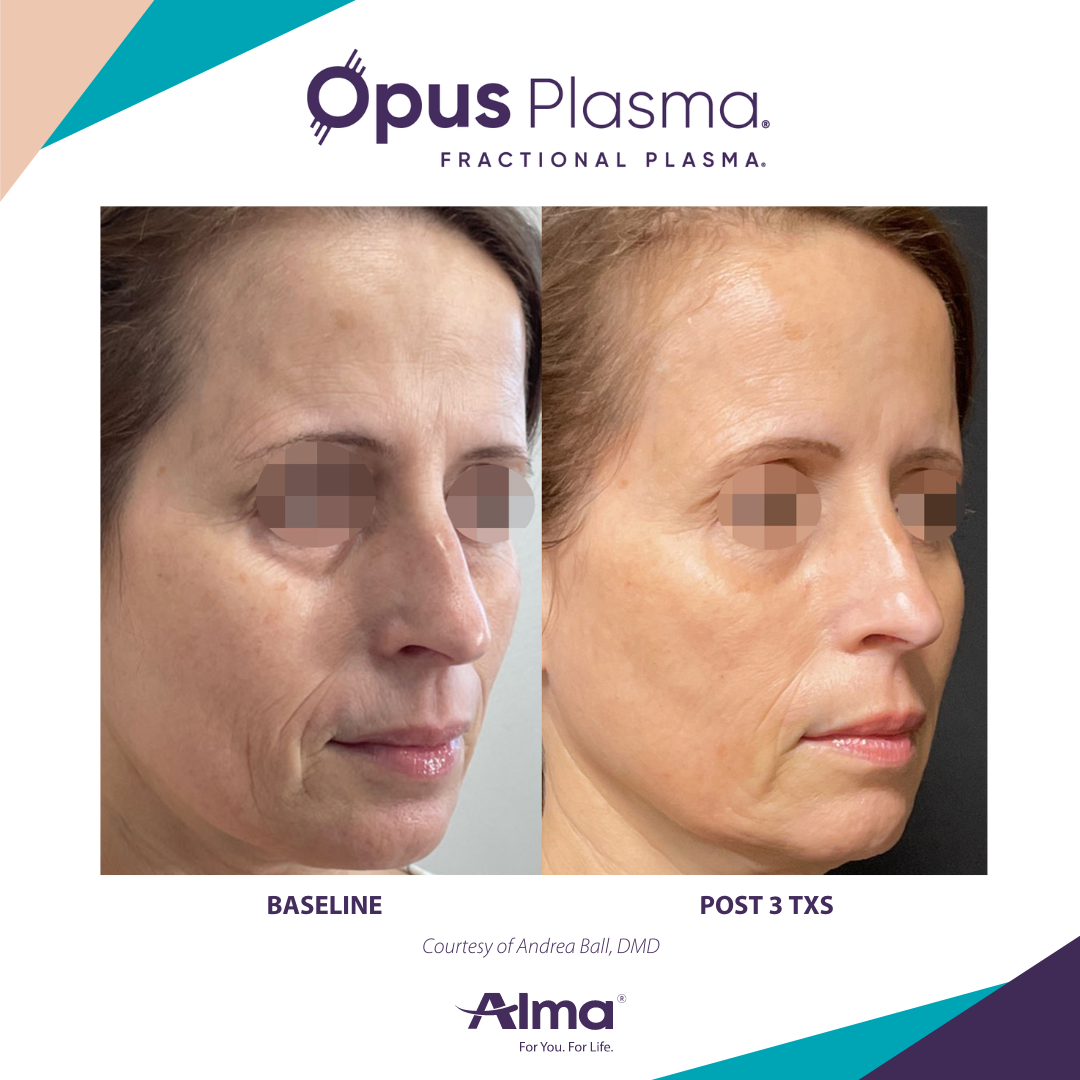 A before and after photo of a woman 's face for opus plasma