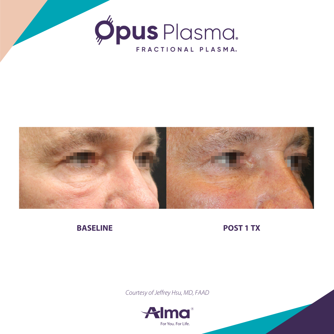 A before and after picture of a man 's eye using opus plasma