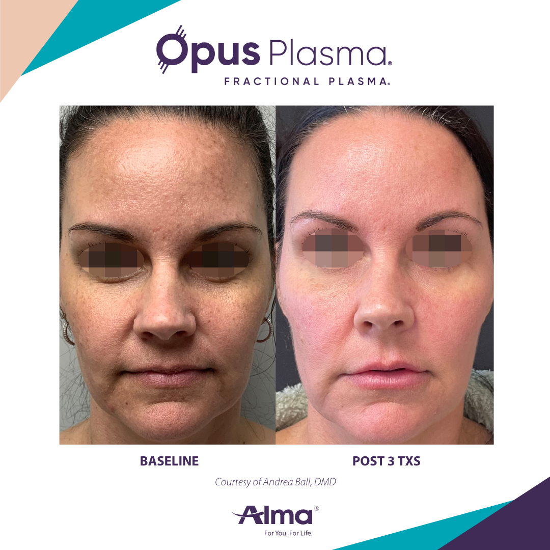 A before and after photo of a woman 's face for opus plasma