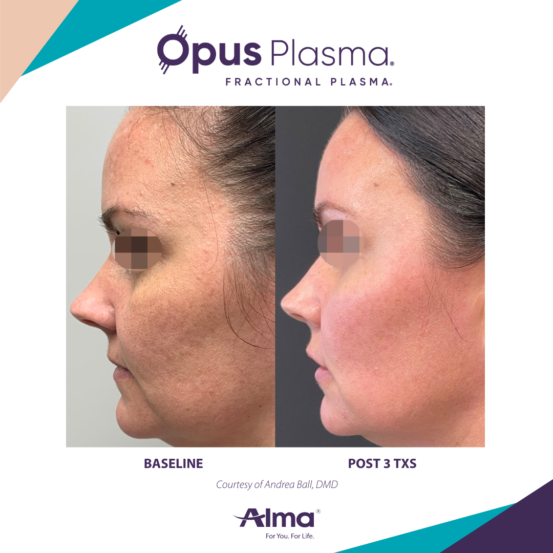 A before and after photo of a woman 's face for opus plasma