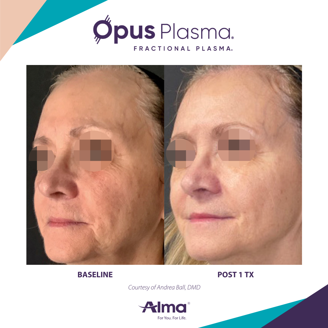 A before and after photo of a woman 's face for opus plasma