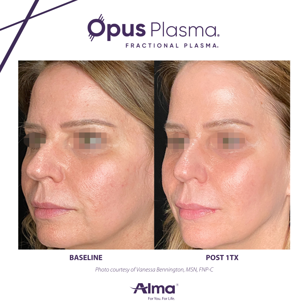 A before and after photo of a woman 's face.