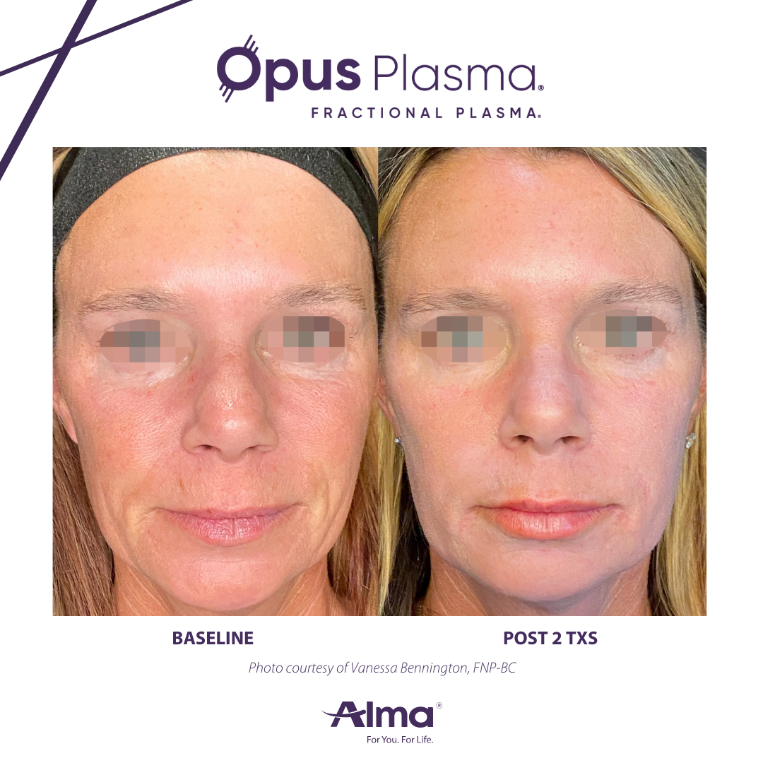 A before and after photo of a woman 's face.