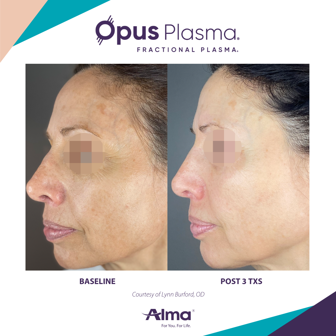 A before and after photo of a woman 's face for opus plasma