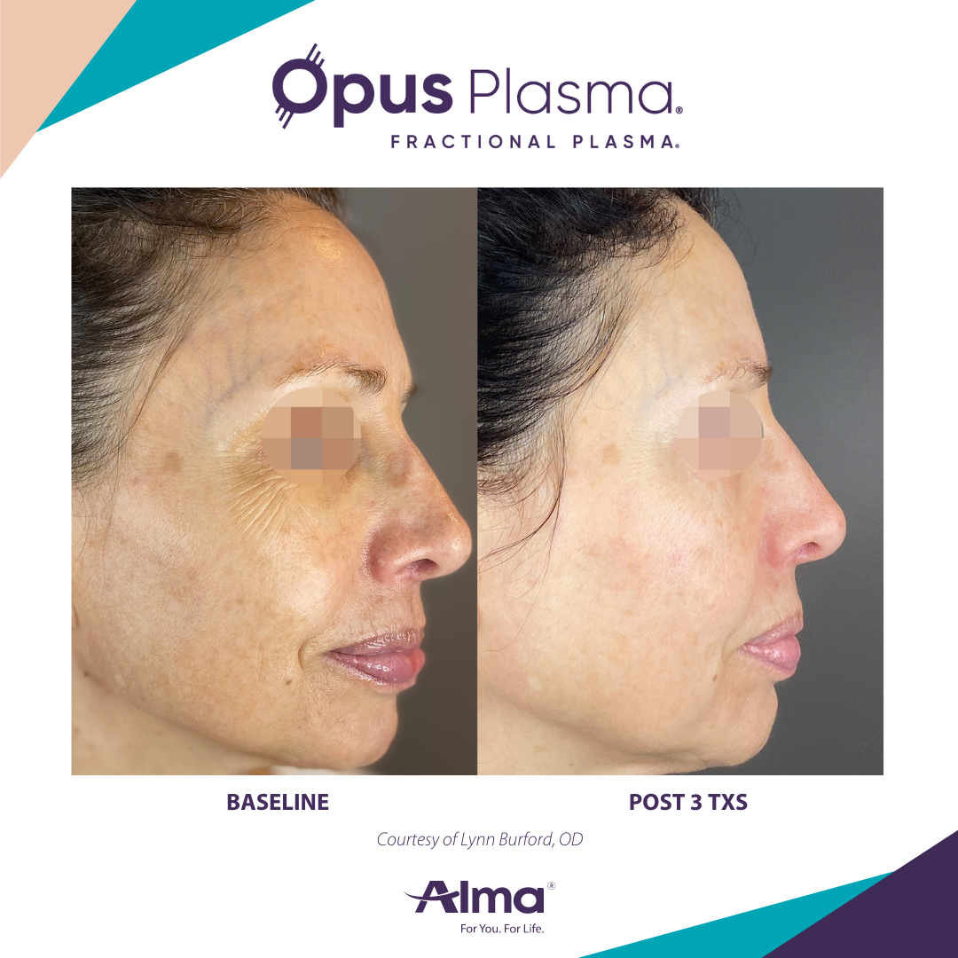 A before and after photo of a woman 's face for opus plasma