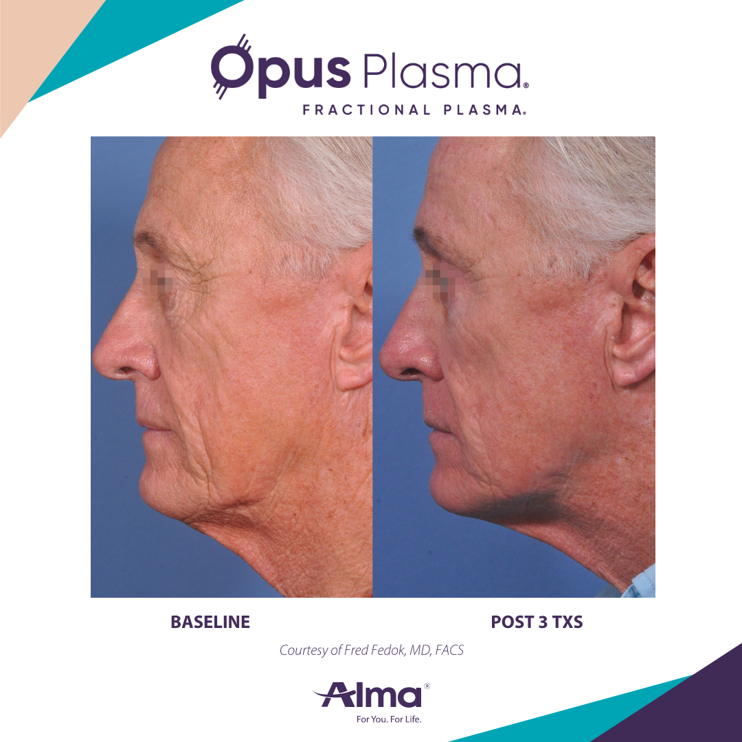 A before and after photo of a man 's face for opus plasma