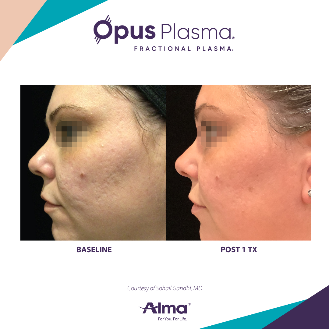 A before and after photo of a woman 's face for opus plasma