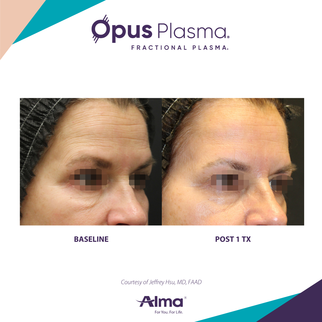 A before and after photo of a woman 's face for opus plasma