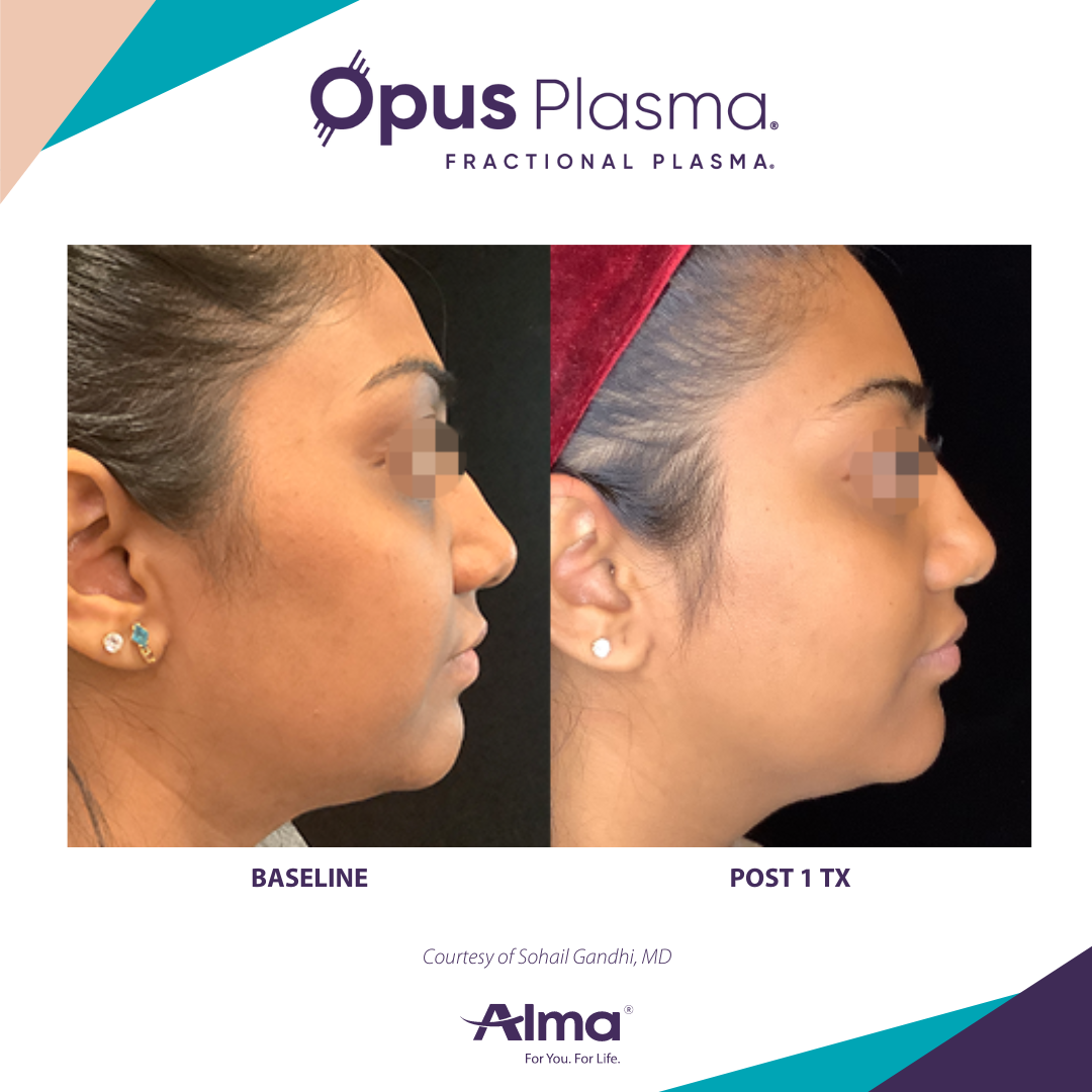 A before and after photo of a woman 's face for opus plasma