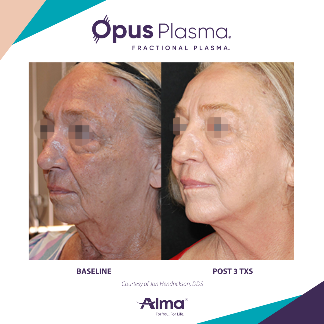 A woman 's face is shown before and after fractional plasma