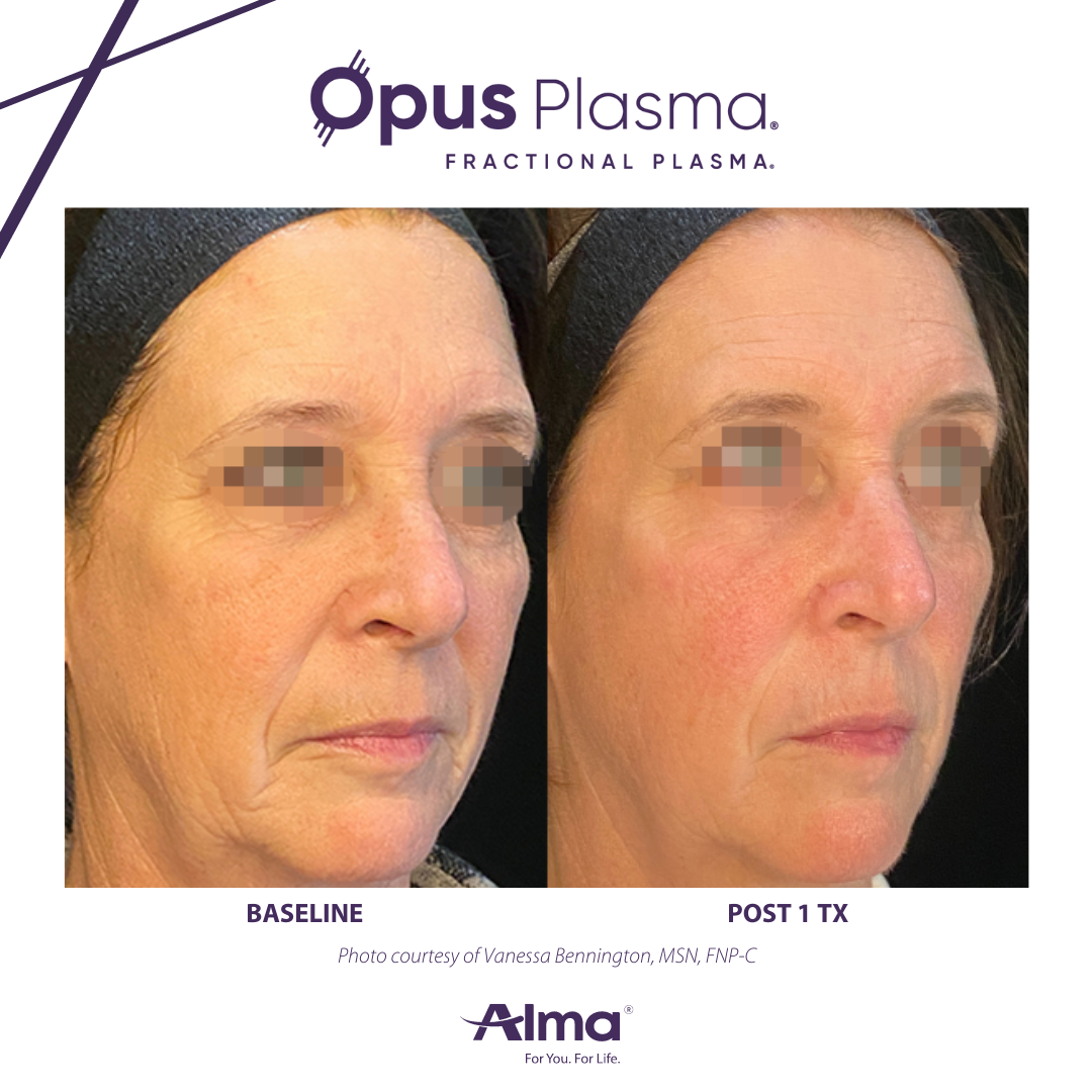 A before and after photo of a woman 's face for opus plasma