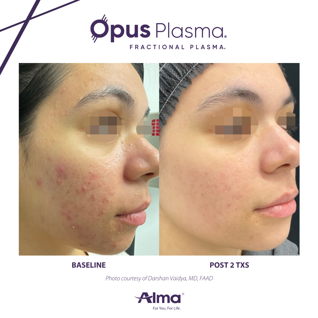 A before and after photo of a woman 's face for opus plasma