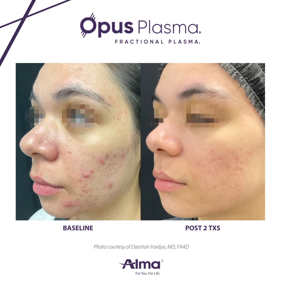 A before and after photo of a woman 's face for opus plasma