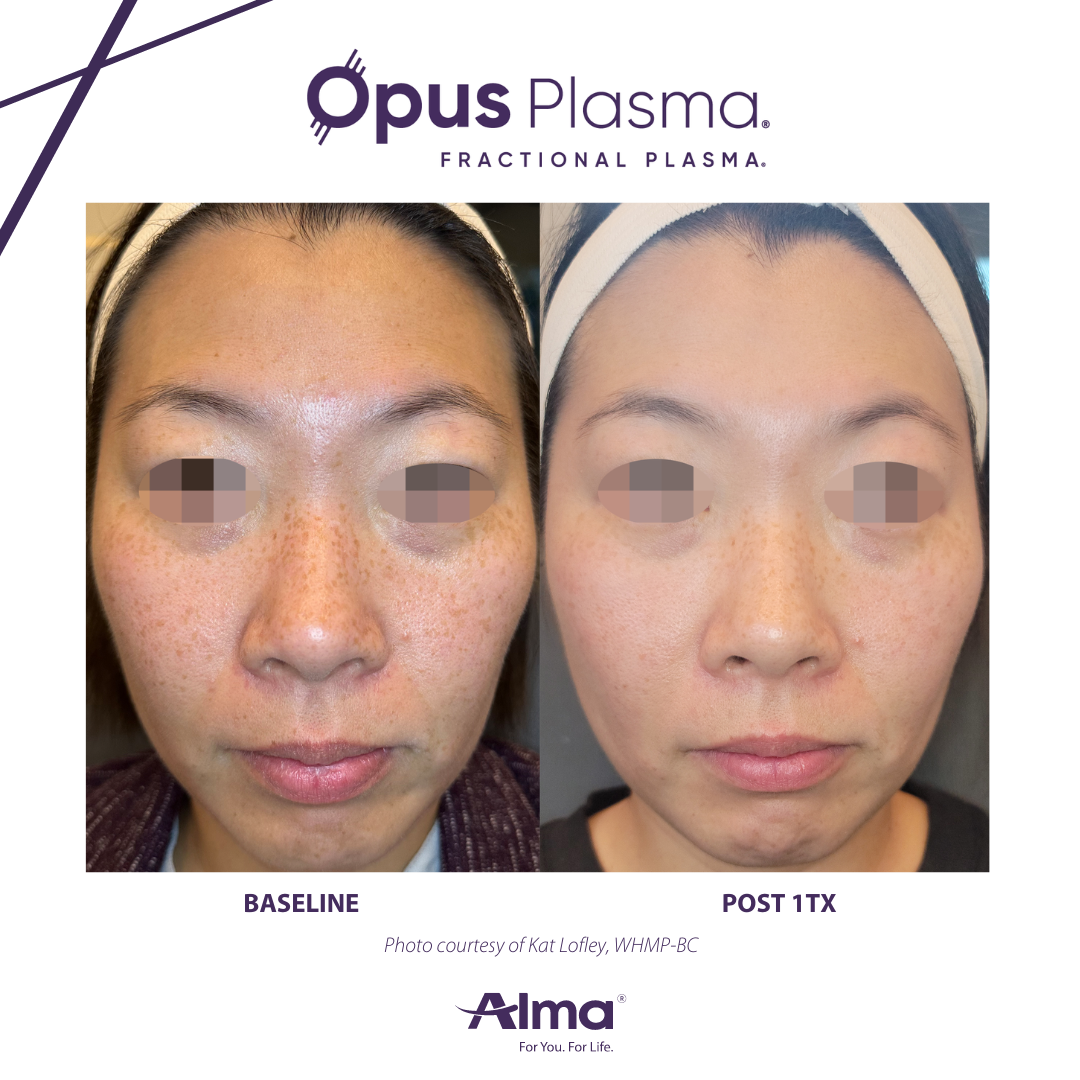 A before and after photo of a woman 's face for opus plasma