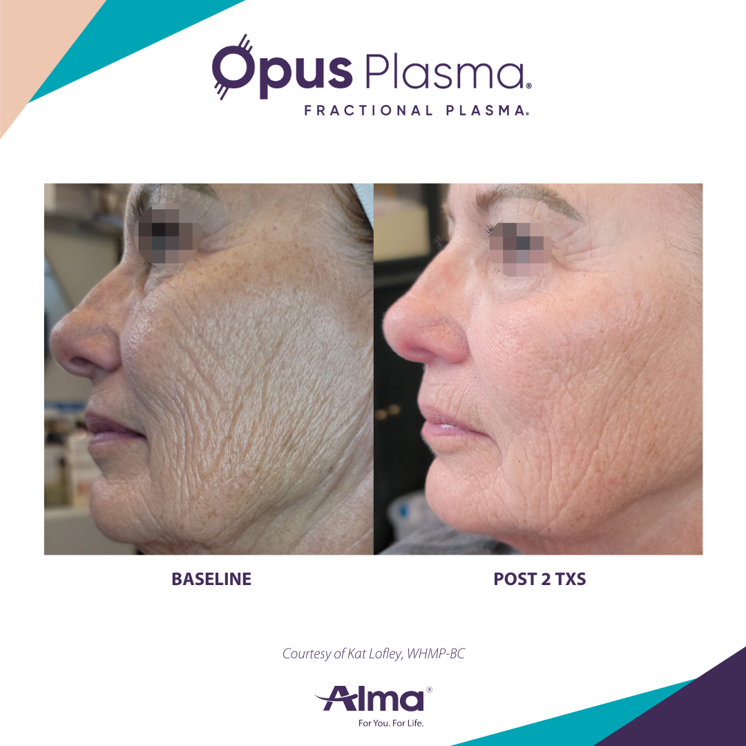 A before and after photo of a woman 's face for opus plasma