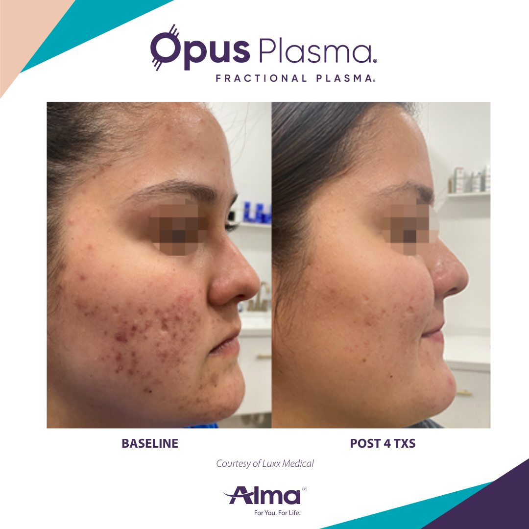 A before and after photo of a woman 's face for opus plasma