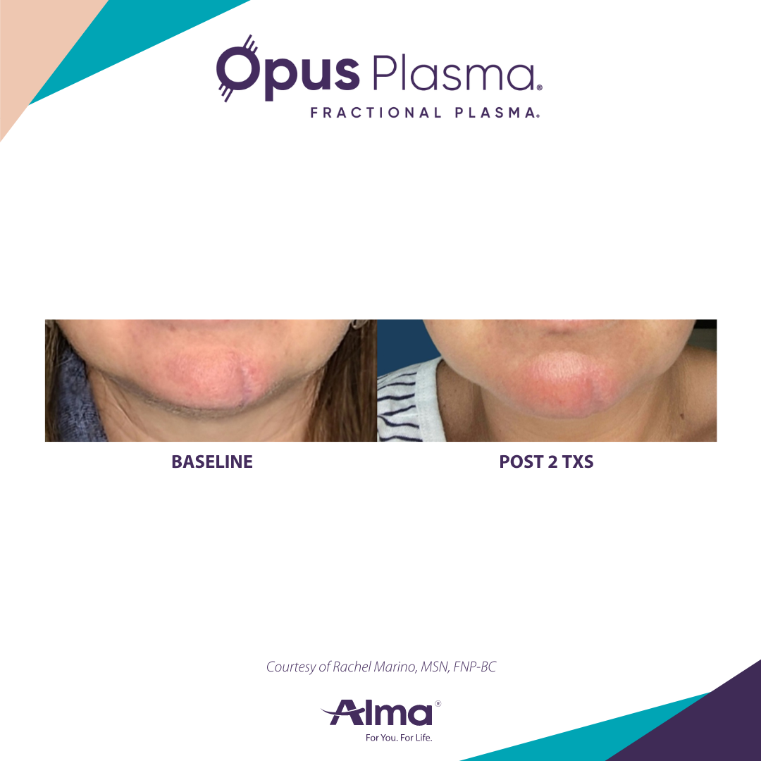 A before and after photo of a woman 's neck