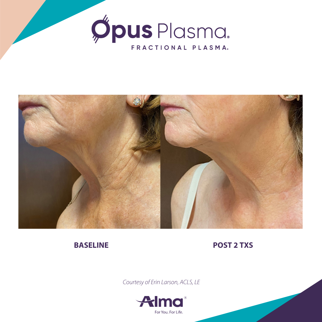 A before and after photo of a woman 's neck