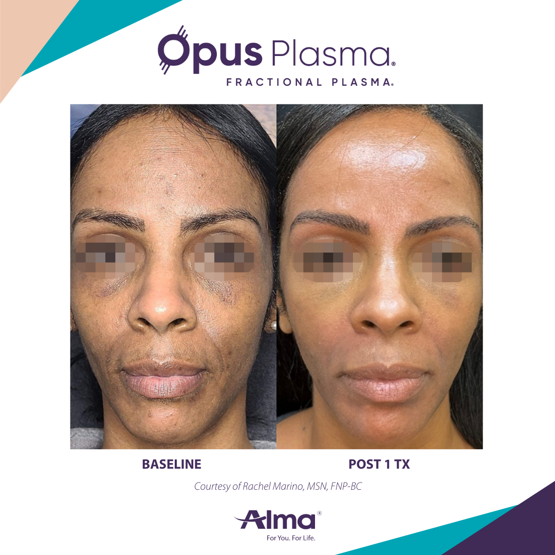 A before and after photo of a woman 's face for opus plasma