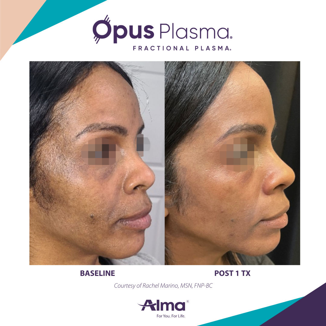 A before and after photo of a woman 's face for opus plasma