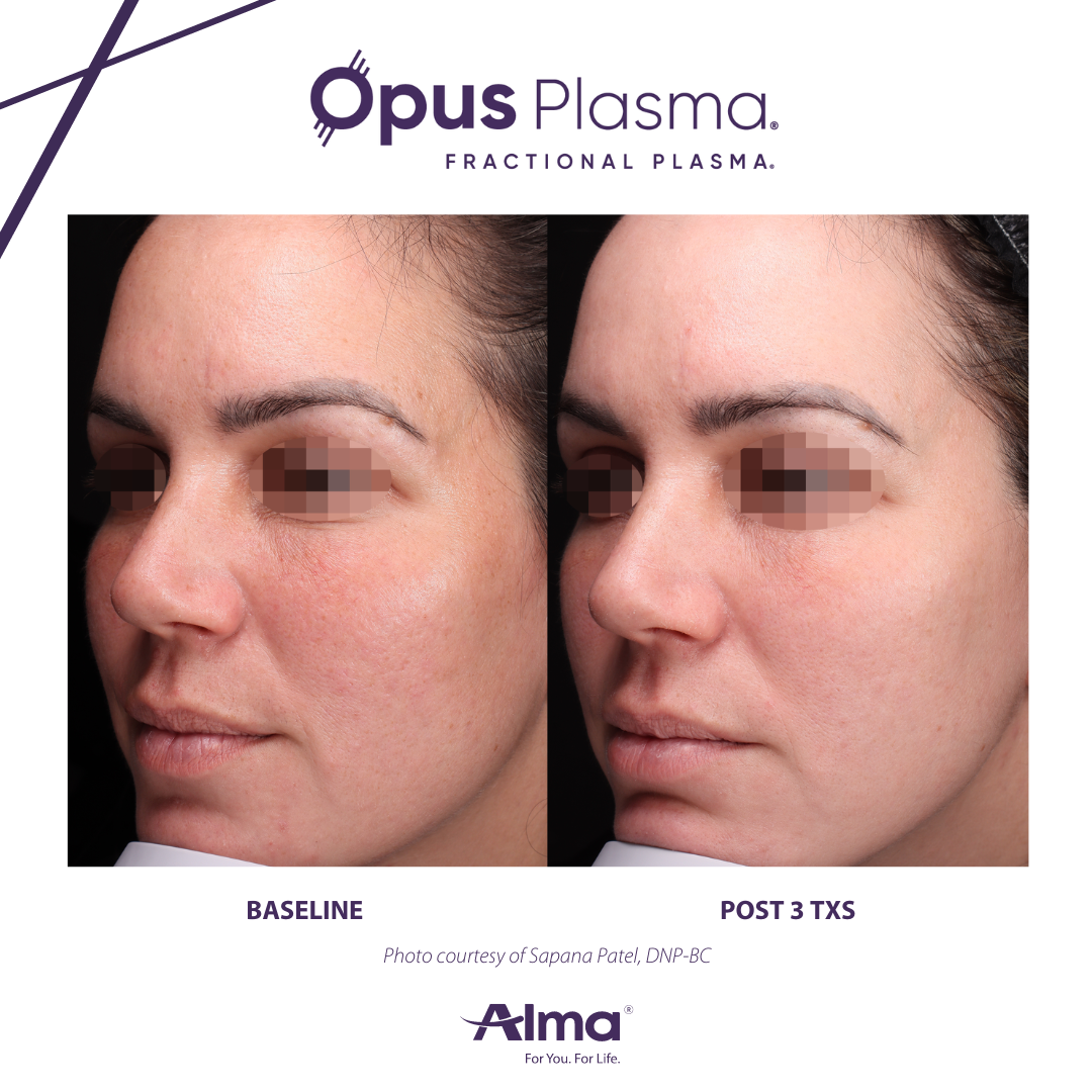 A before and after photo of a woman 's face for opus plasma