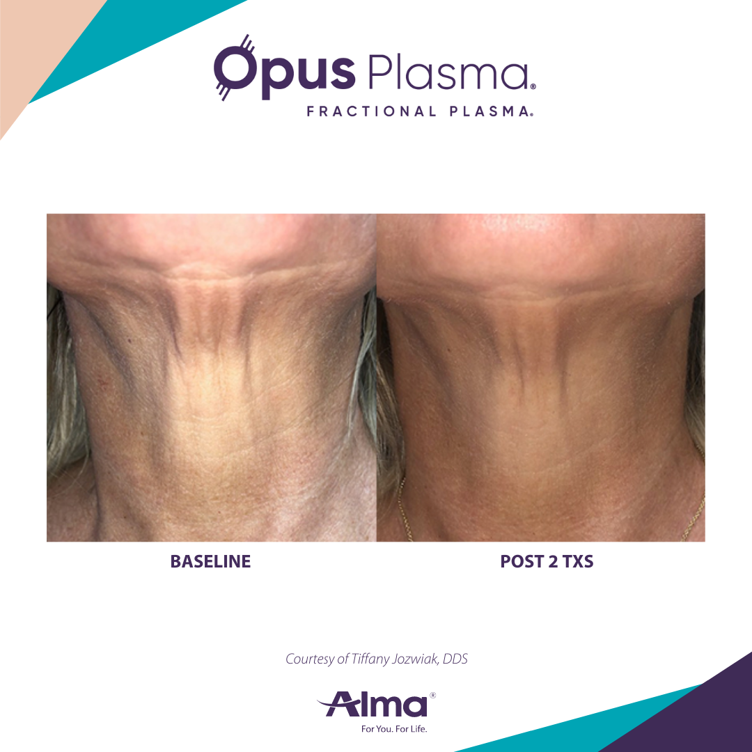 A before and after photo of a woman 's neck