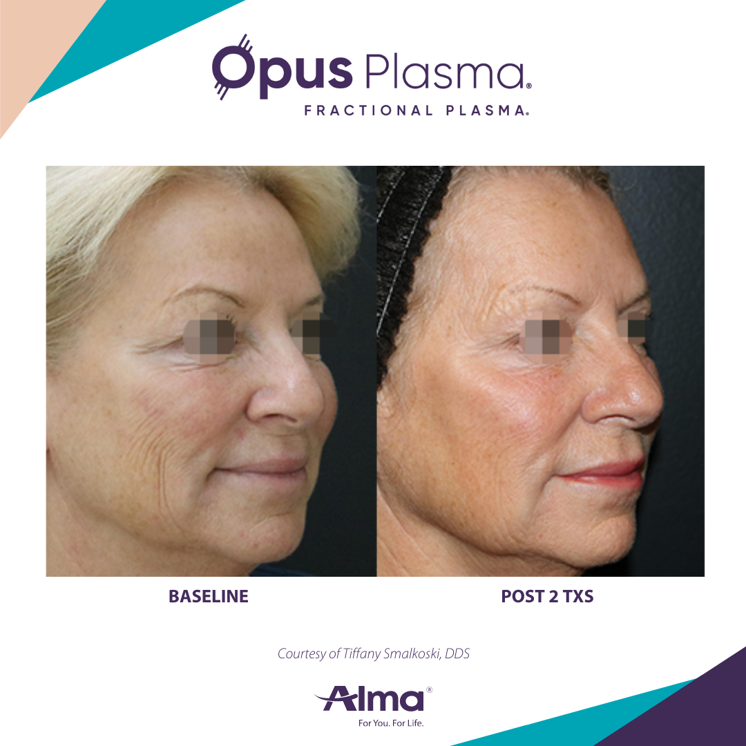 A before and after photo of a woman 's face for opus plasma