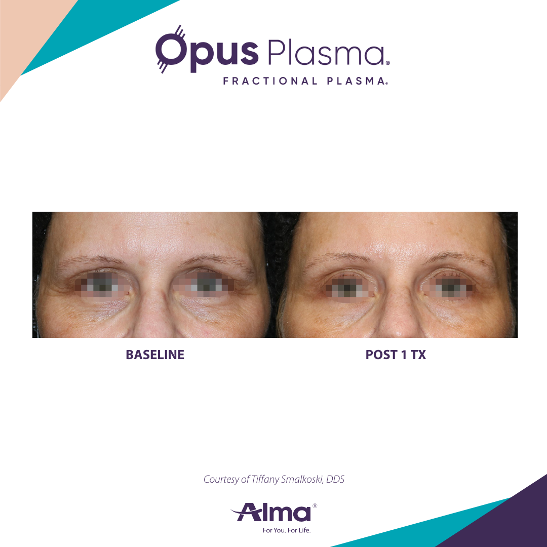 A before and after photo of a woman 's face for opus plasma