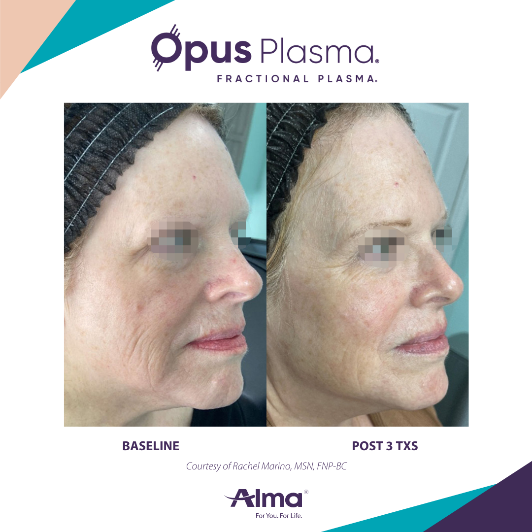A before and after photo of a woman 's face for opus plasma