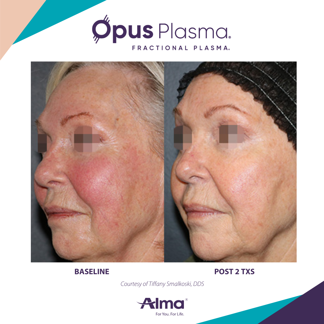 A before and after photo of a woman 's face for opus plasma
