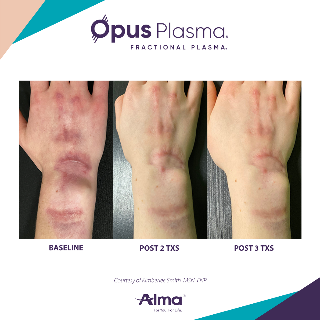 Three pictures of a person 's hands with opus plasma written on the bottom