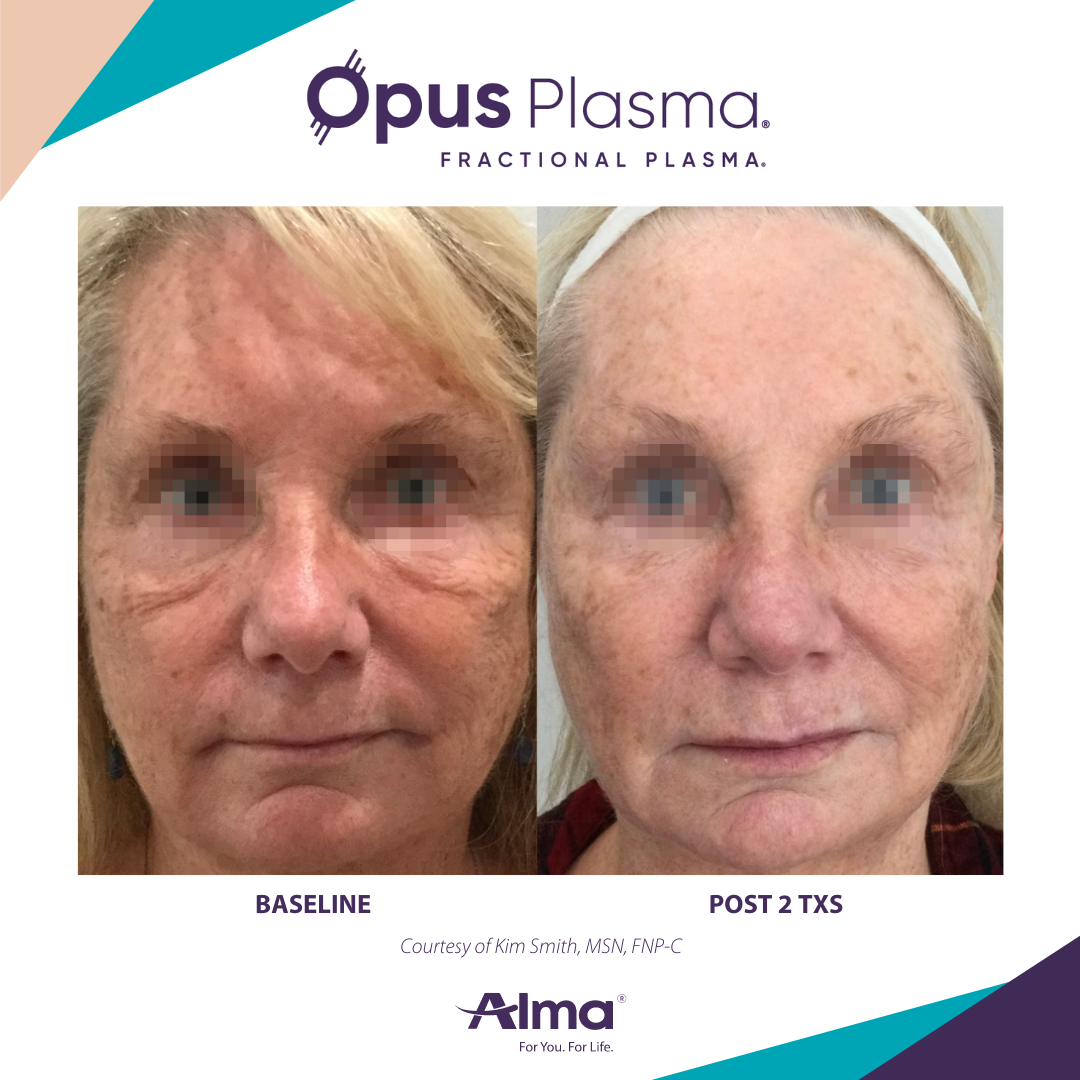 A before and after photo of a woman 's face for opus plasma
