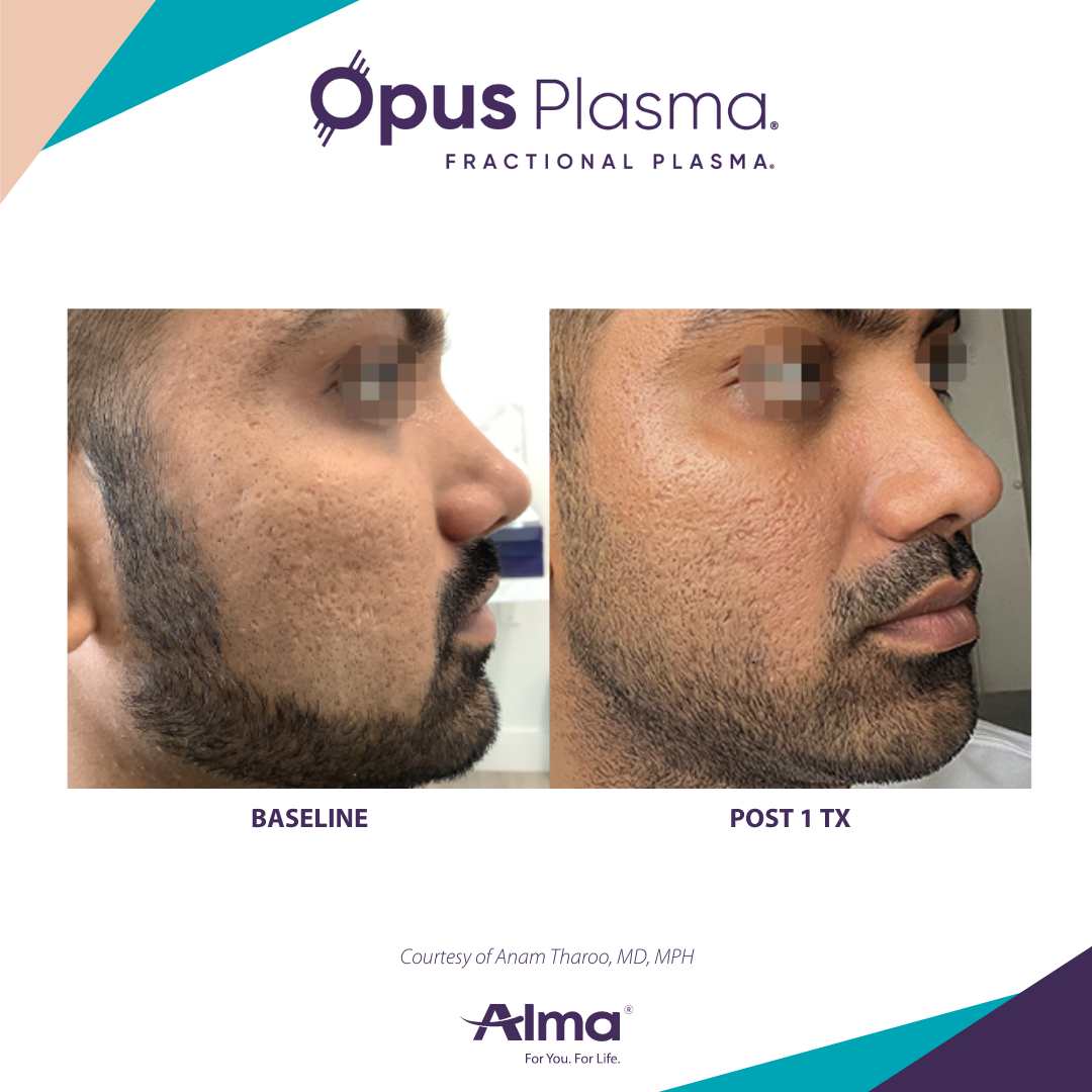 A man with a beard is shown before and after a fractional plasma treatment