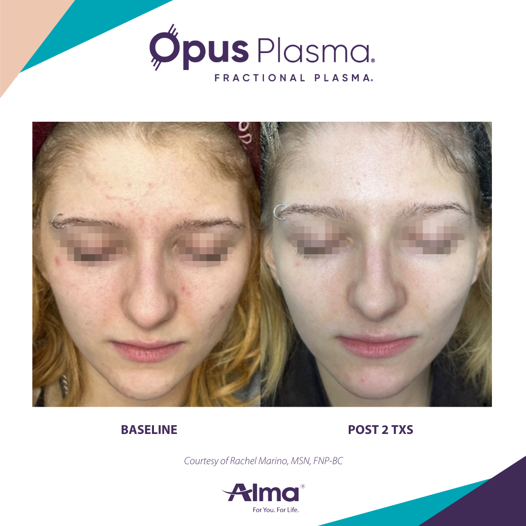 A before and after photo of a woman 's face for opus plasma